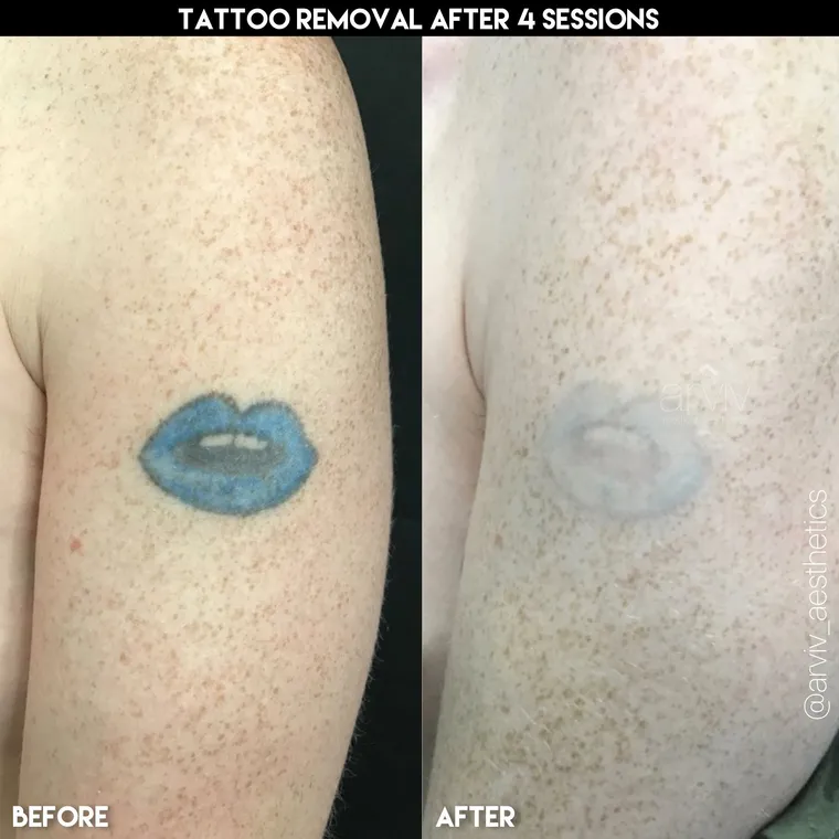 Laser tattoo removal before and after result 1 at Arviv Medical Aesthetics