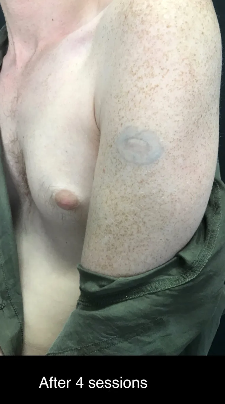 Laser tattoo removal before and after result 2 at Arviv Medical Aesthetics