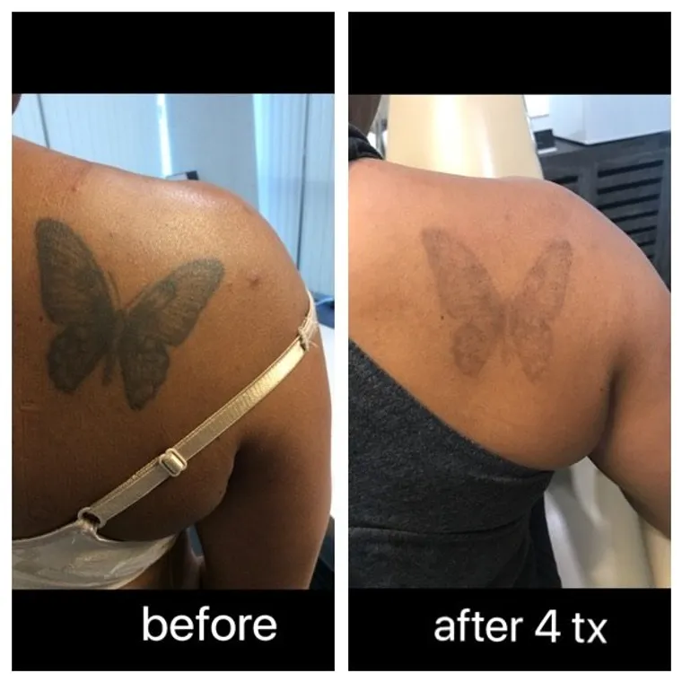 Laser tattoo removal before and after result 3 at Arviv Medical Aesthetics
