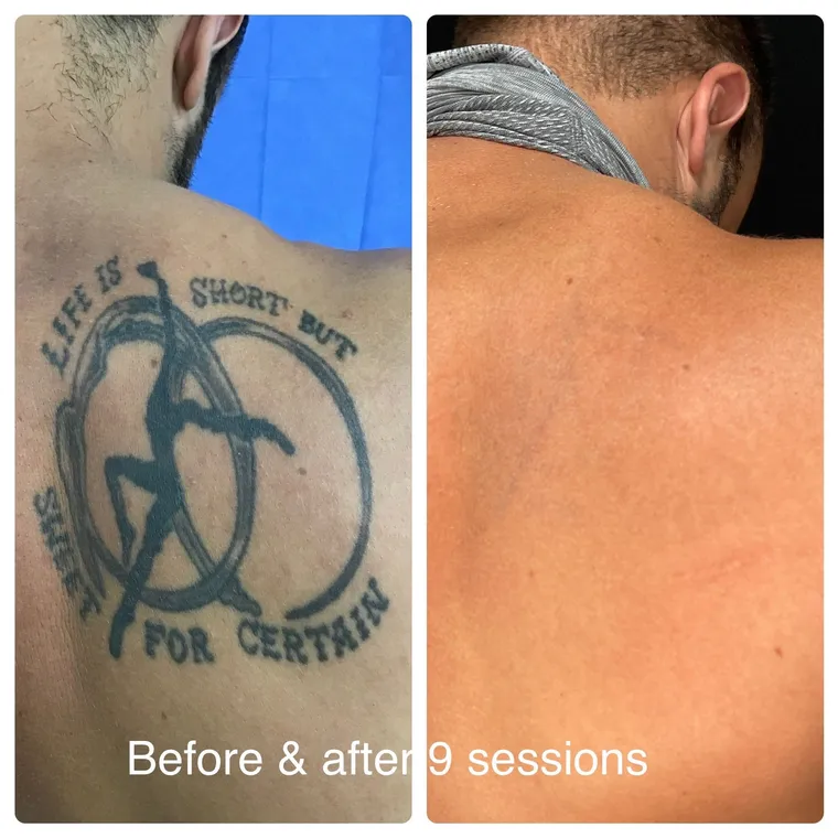 Laser tattoo removal before and after result 4 at Arviv Medical Aesthetics