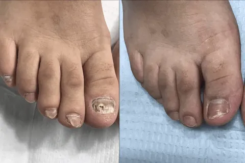 Toenail Fungus Treatment before and after result at Arviv Medical Aesthetics
