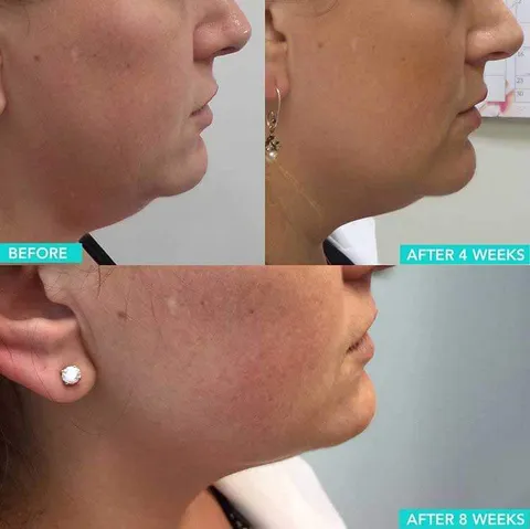 Ultherapy before and after result 1 at Arviv Medical Aesthetics