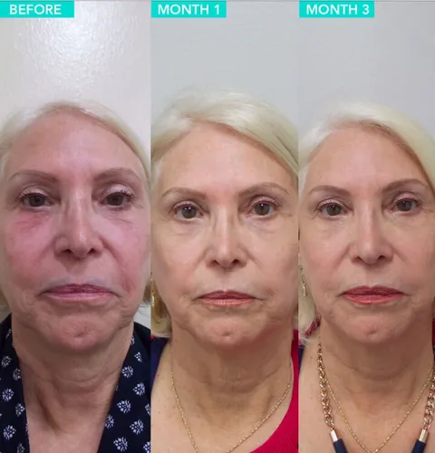 Ultherapy before and after result 2 at Arviv Medical Aesthetics