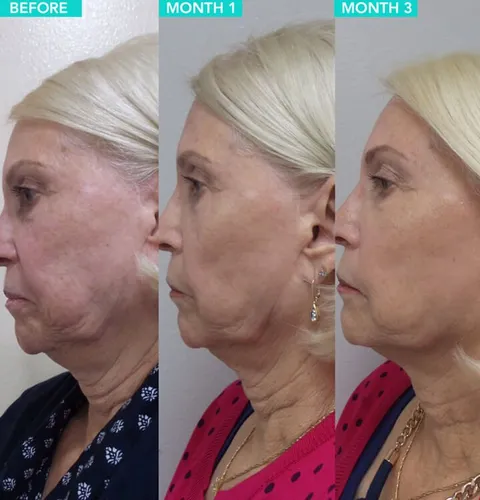 Ultherapy before and after result 3 at Arviv Medical Aesthetics