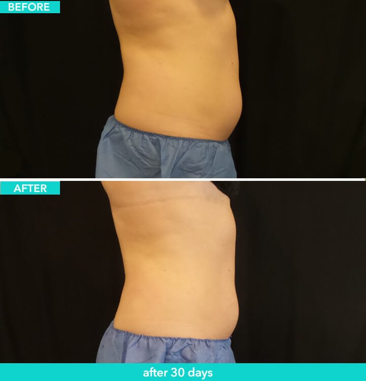 Coolsculpting on the side: Before and After