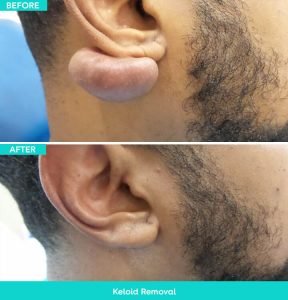 Scar Revision Before and After Pictures in Miami, FL