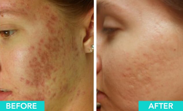 Microneedling