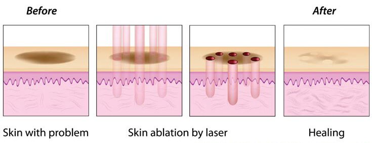 DOT Fractional CO2 Laser Spring Hill, FL