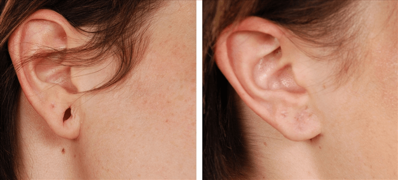 How To Repair Ear Lobe Slits & Holes