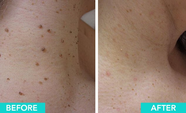 Skin Tag Removal Before And After