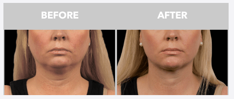 Before and After Coolsculpting on the chin