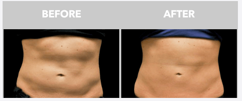 Before and After Coolsculpting on the Abdomen