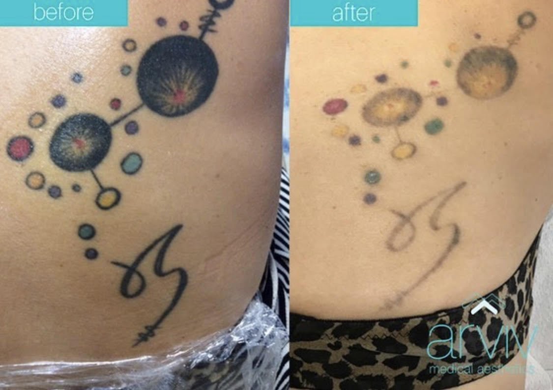 Dr. Simon Ourian - Epione - 😷 Treatment: Laser Tattoo Removal 🎯 Purpose:  Removal of unwanted tattoo 👓 How it works: Laser destroys the pigments 🎉  Results: Permanent ✏ Note: Individual results
