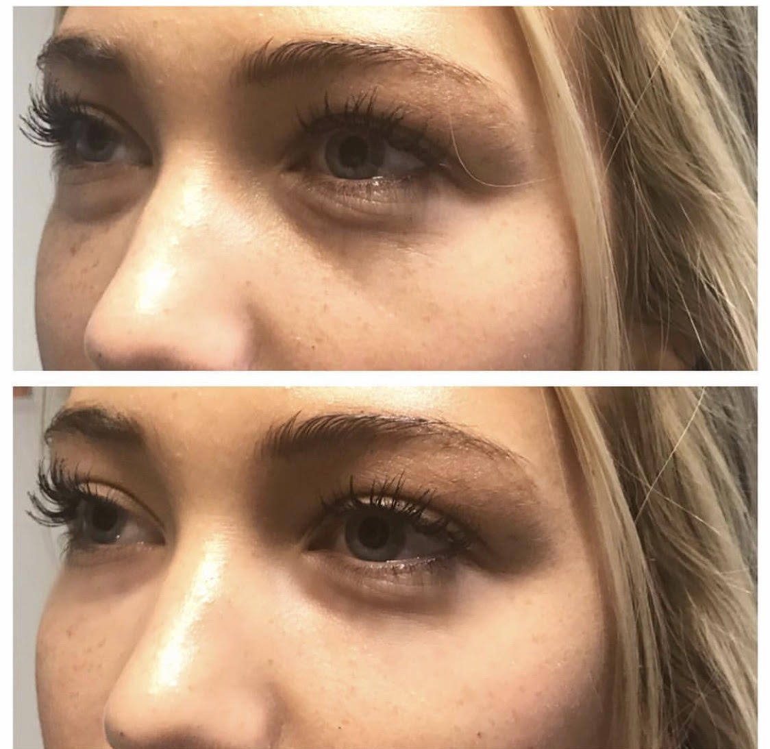 Under Eye Fillers Before 2