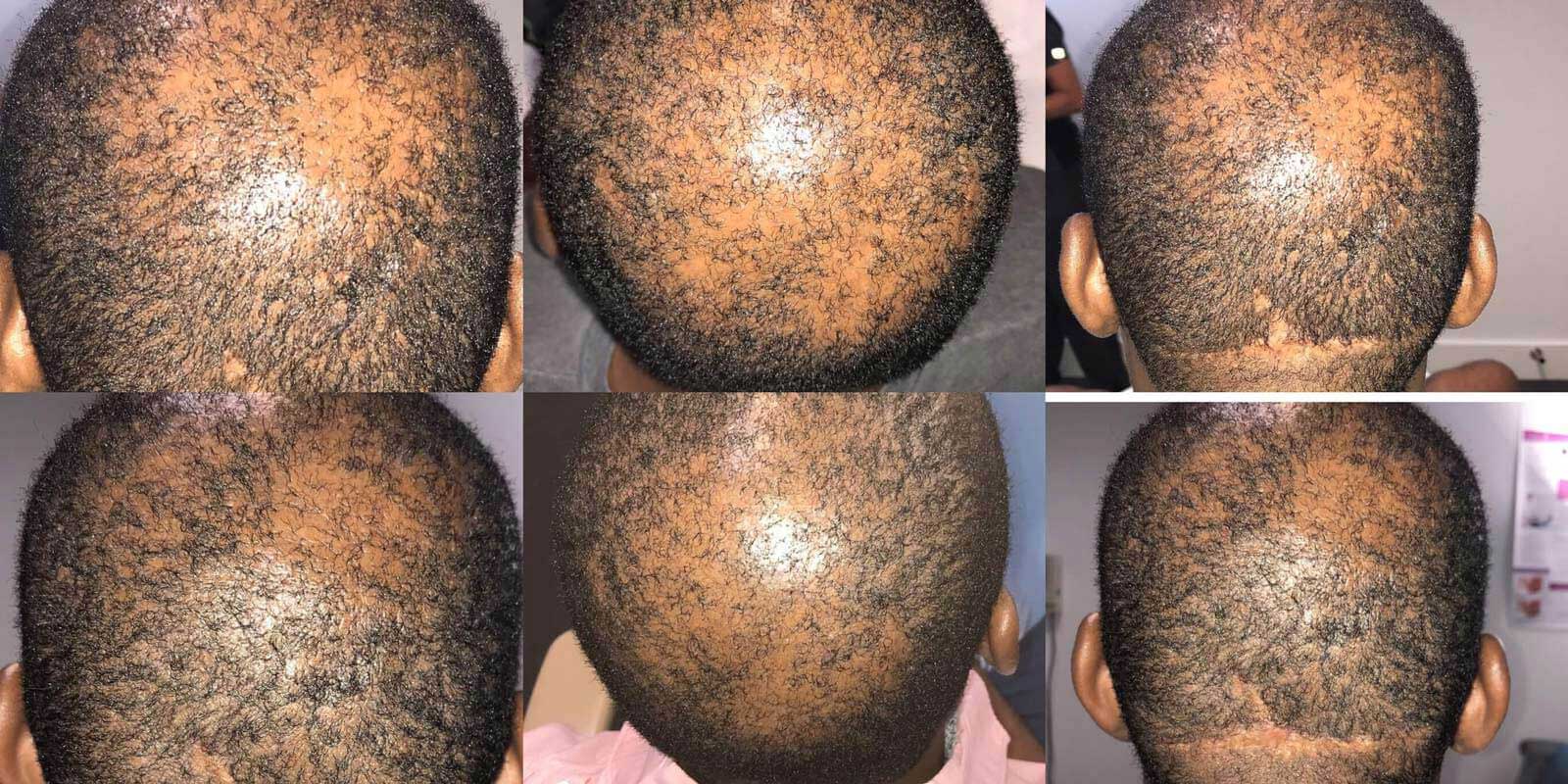 Studio Scalp – PRP injections for Hair – Before (top), After (bottom)