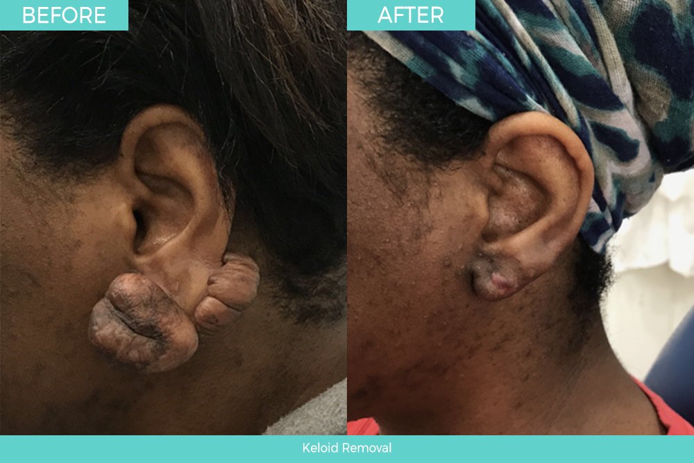 Before After ear