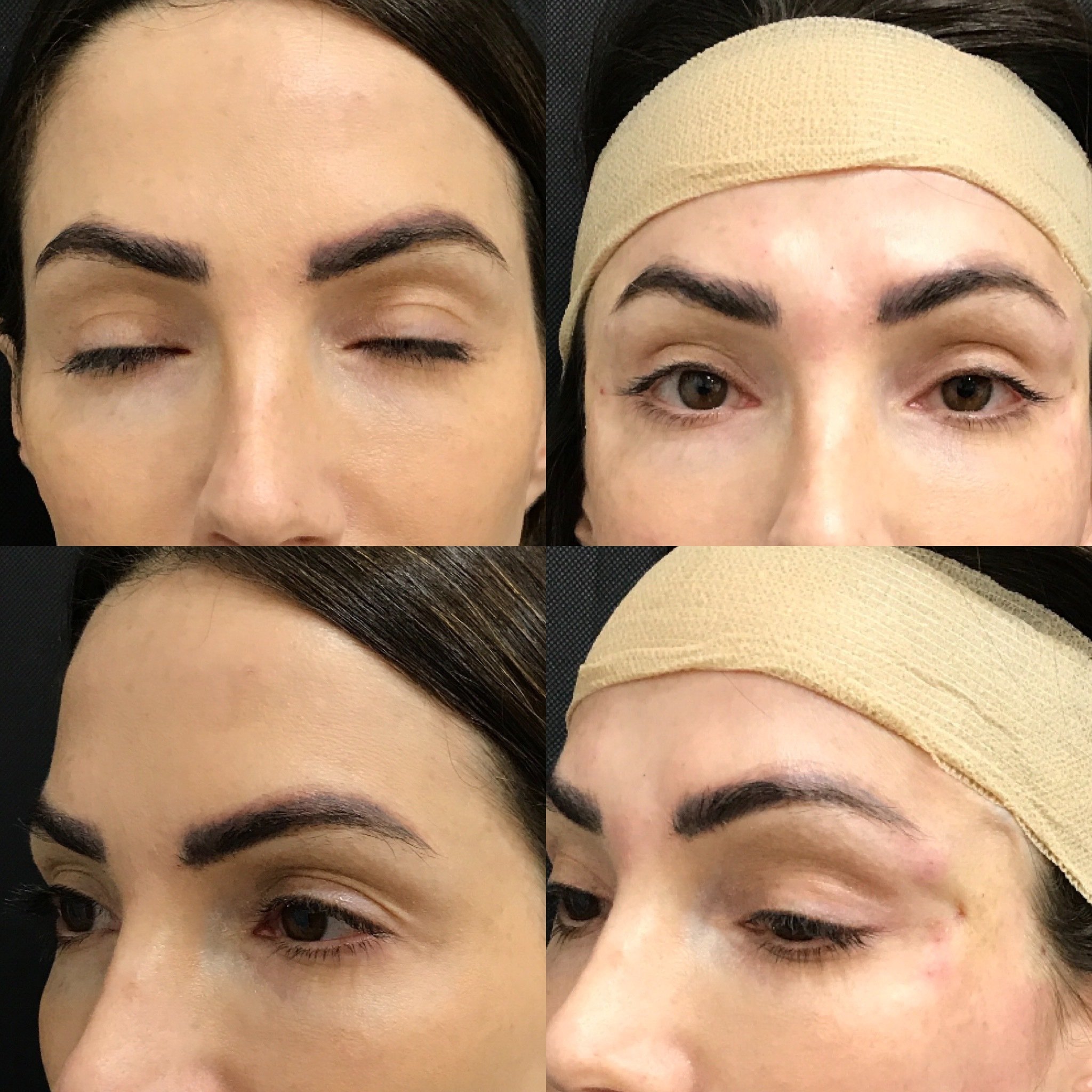 Foxy shop eye lift