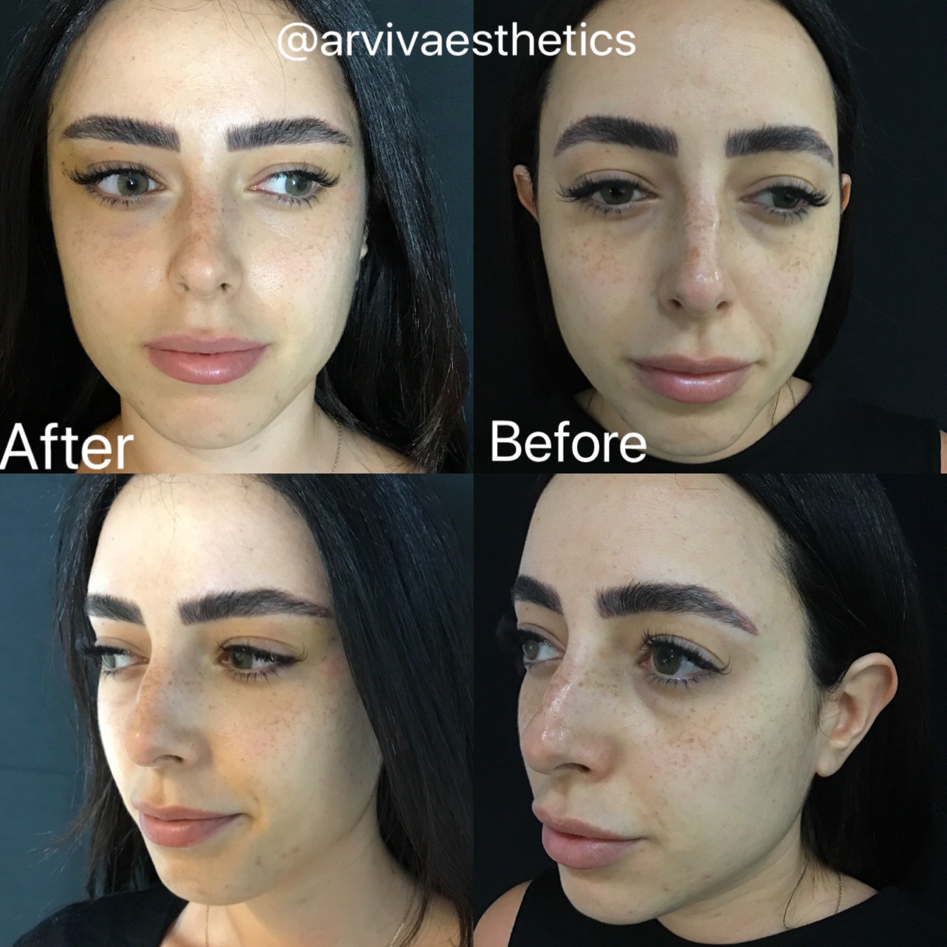 fox eye lift before and after