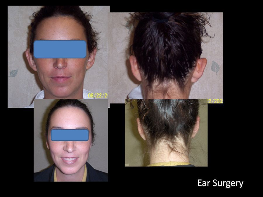 Facial Plastic Surgery Before and After