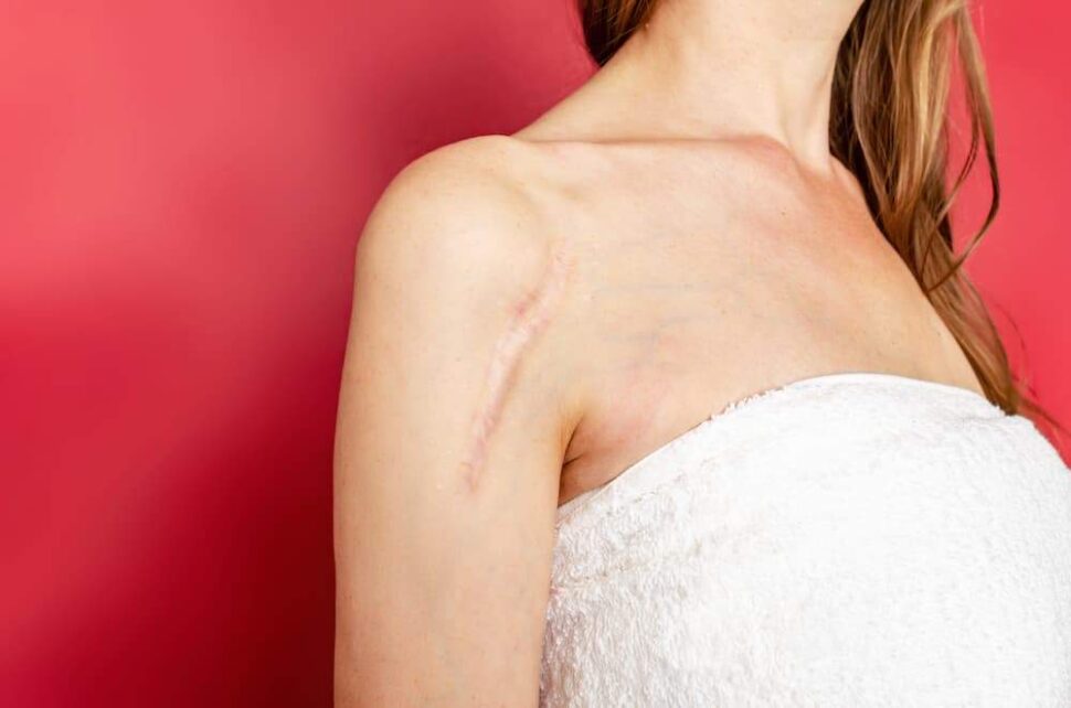 woman with scar on shoulder