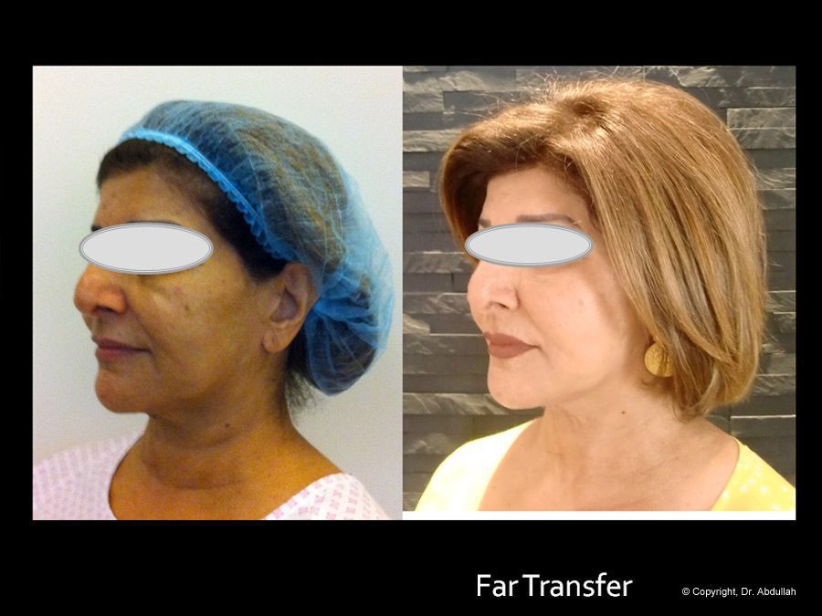 Facial Surgery Before and After Photos