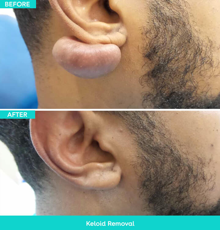 keloid before after