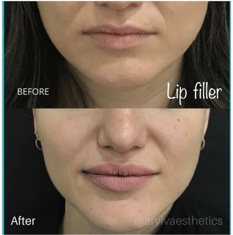 Dermal Fillers & Lip Injection Tampa | Arviv Medical Aesthetics