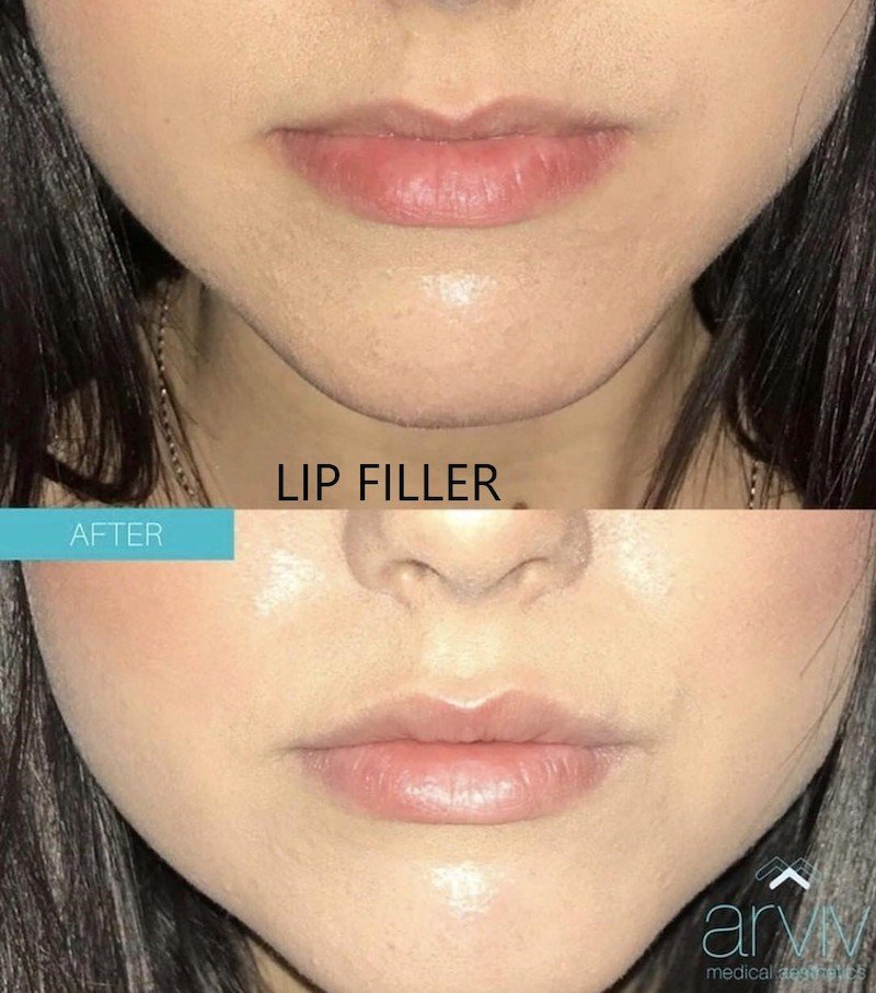 LIP FILLER7