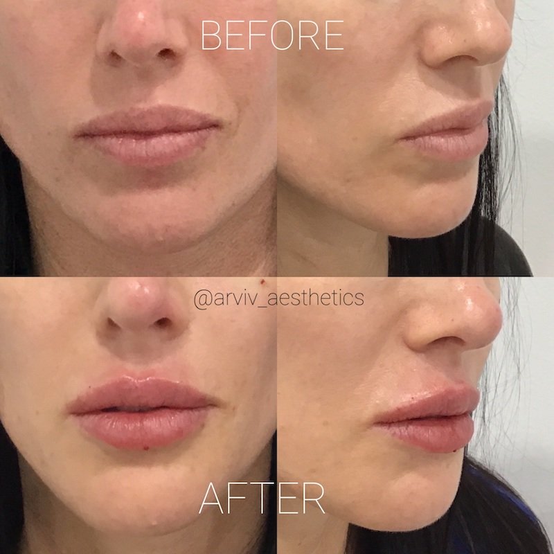 https://arvivaesthetics.com/wp-content/uploads/2020/11/LIPFILL6.jpg