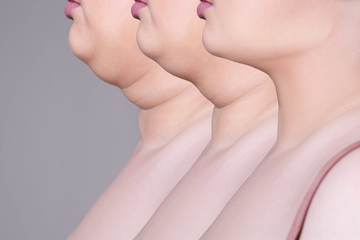 Double chin, skin rejuvenation on the neck, before after anti aging concept