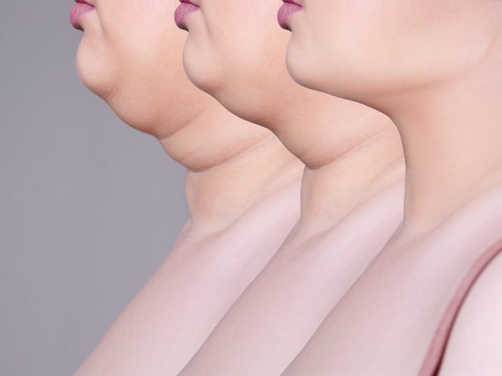 How To Get Rid of Double Chin