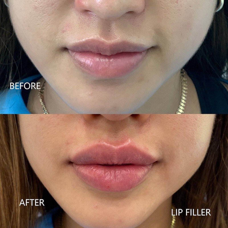 lip filer