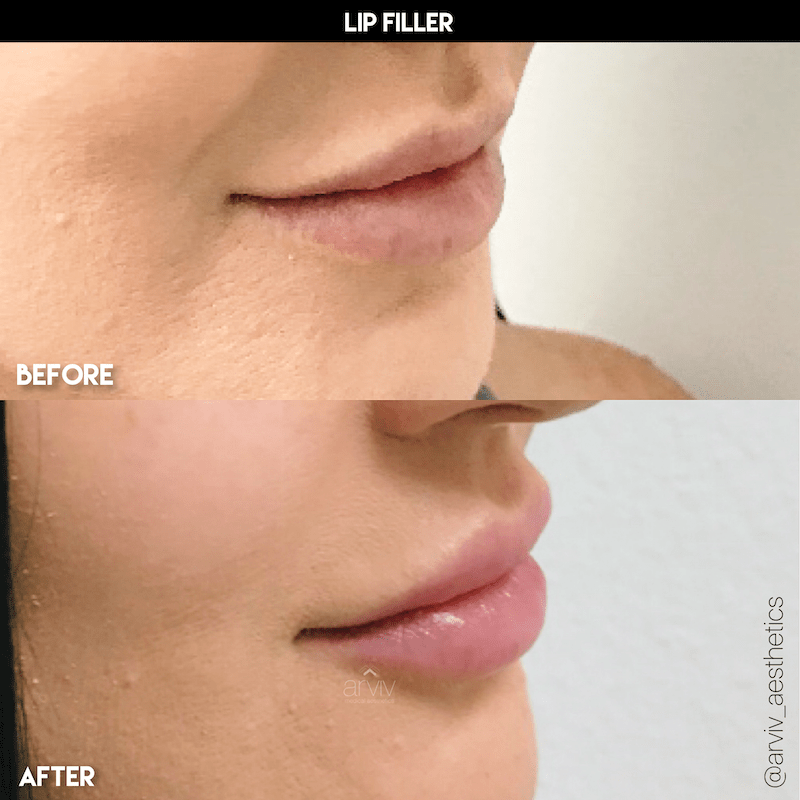 lip filler4