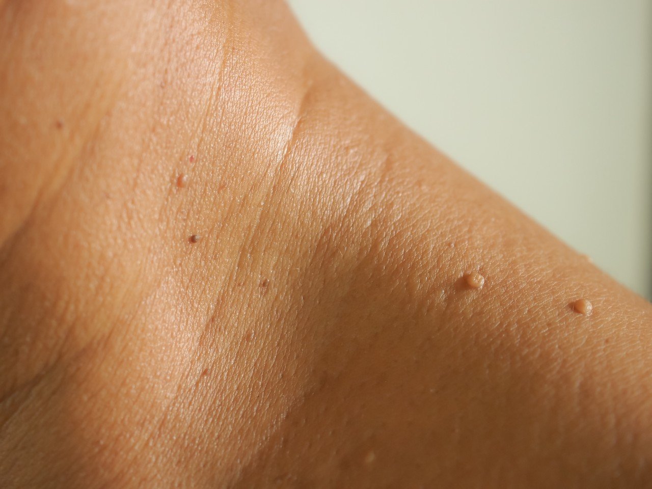 skin tag removal miami 1