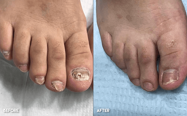Hongos en las uñas de los pies antes y después