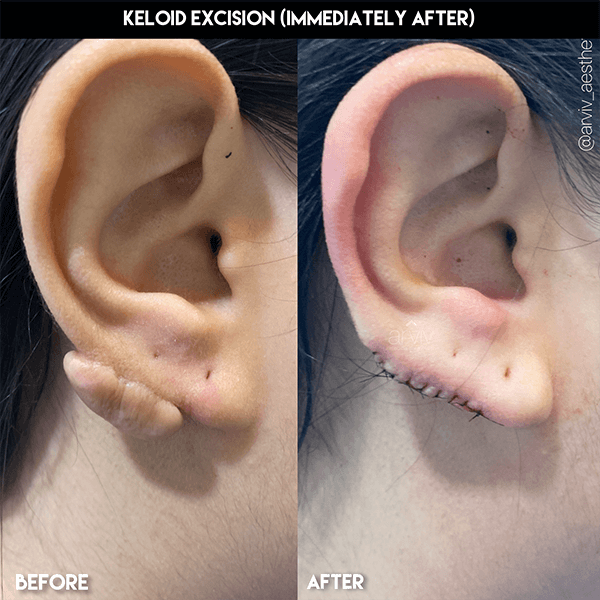 Tampa Keloid Removal & Treatment Prices & Info Arviv Medical Aesthetics