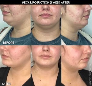 Liposuction before and after on the neck and chin