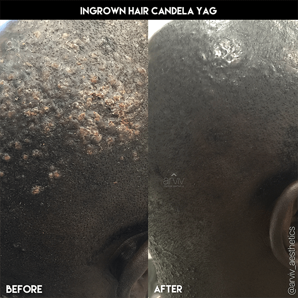 Tampa Laser Hair Removal Cost & Info Arviv Medical Aesthetics