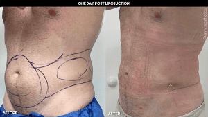 Liposuction before and after on the stomach