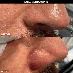 Laser Vein Removal