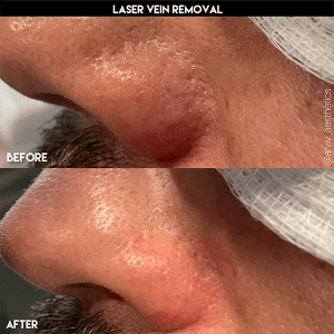 Laser Vein Removal