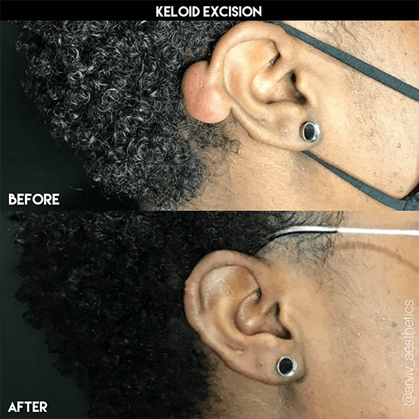 Tampa Keloid Removal & Treatment Prices & Info Arviv Medical Aesthetics