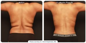 renuvion-before-after-back-axilla-and-flanks-case1-photos_72dpi