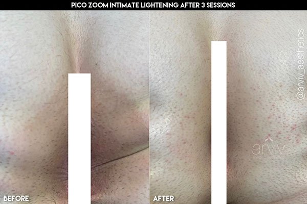 Intimate Lightening/Bleaching in Cape Coral, Florida — The Skin