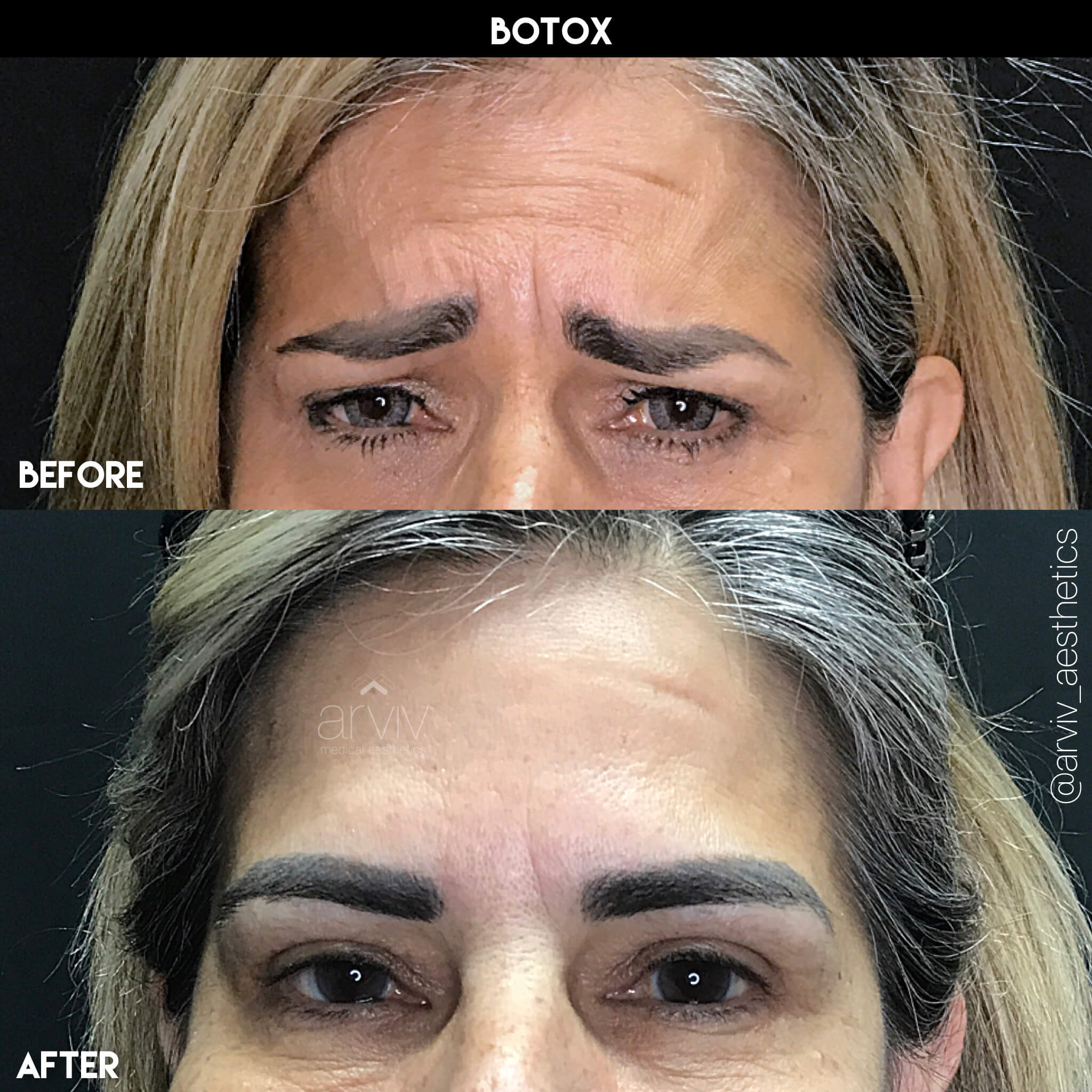 Botox & Dysport