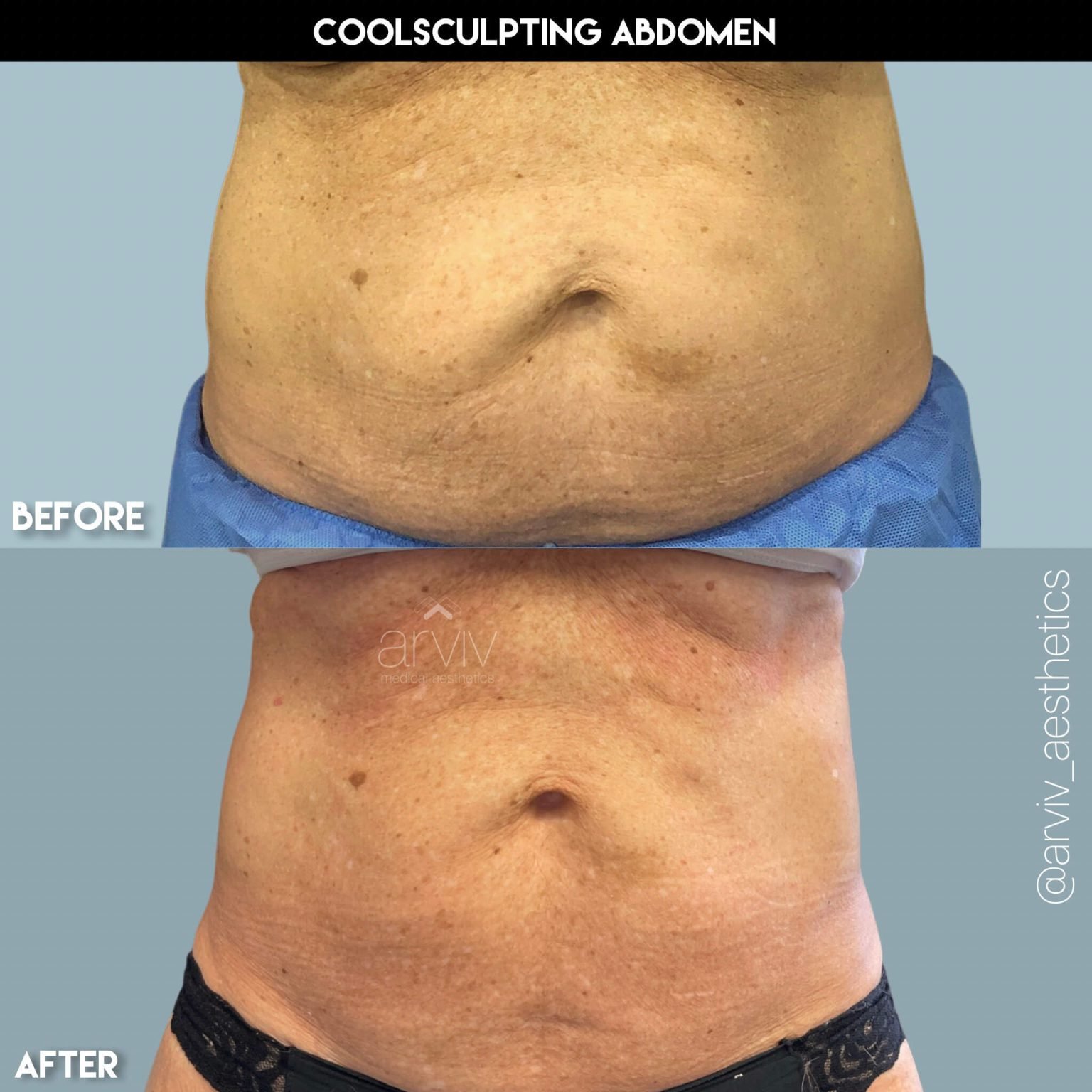 CoolSculpting Fat Loss Treatment Cost Tampa, FL Arviv Medical Aesthetics