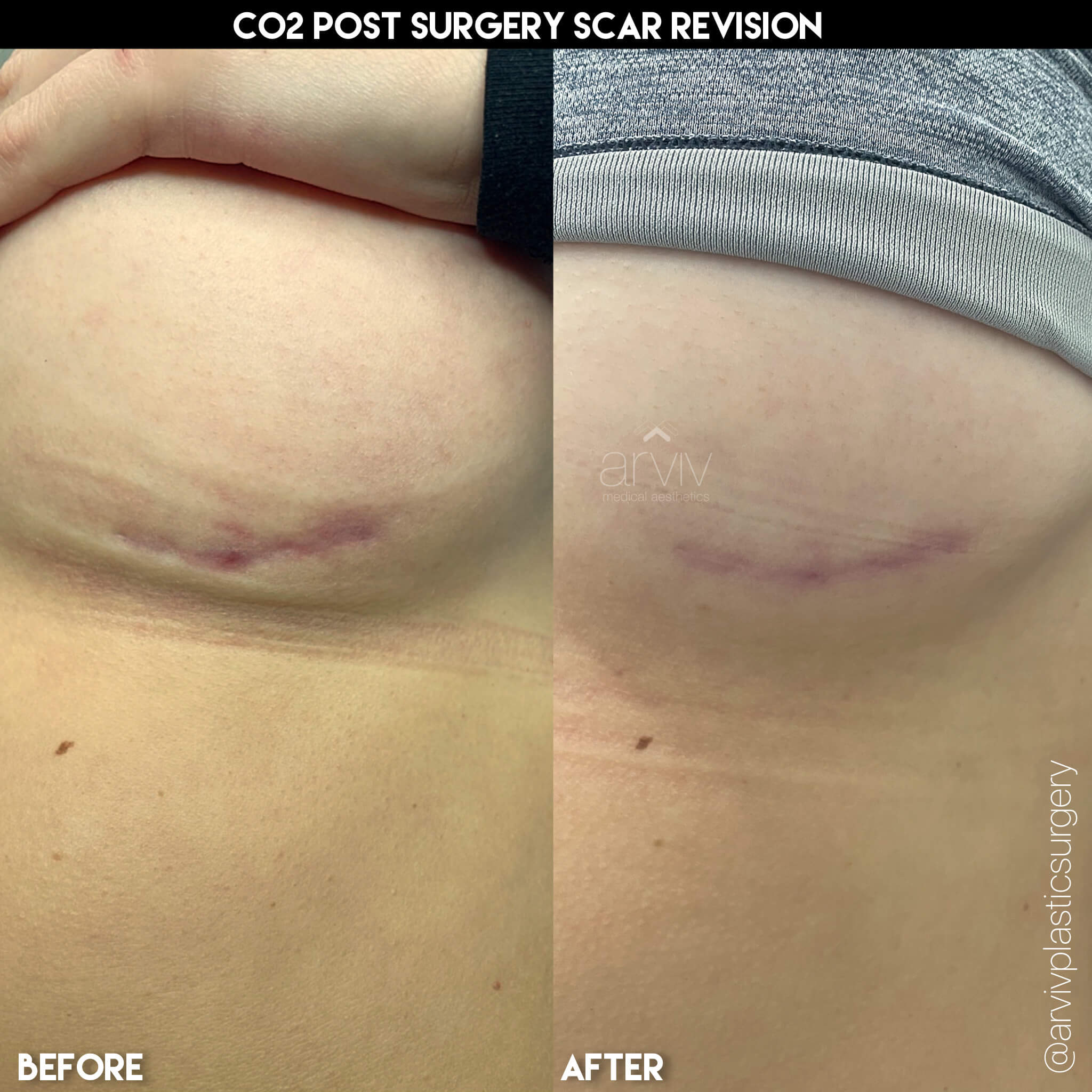 CO2 Laser Skin Resurfacing Near Tampa, FL