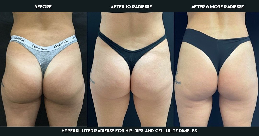 Non-Surgical Butt Augmentation New Jersey - Reflections Center