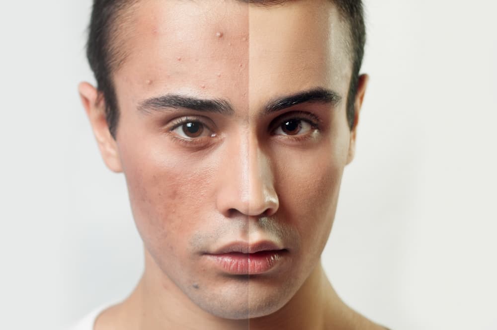 Acne Removal Before and After