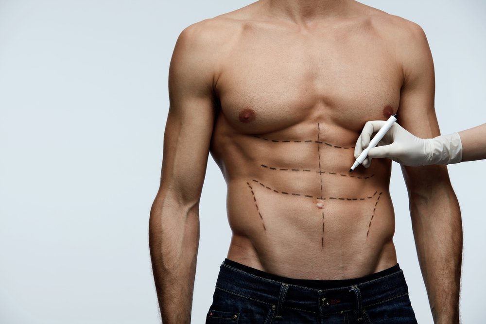 Abs being defined with marker by doctor
